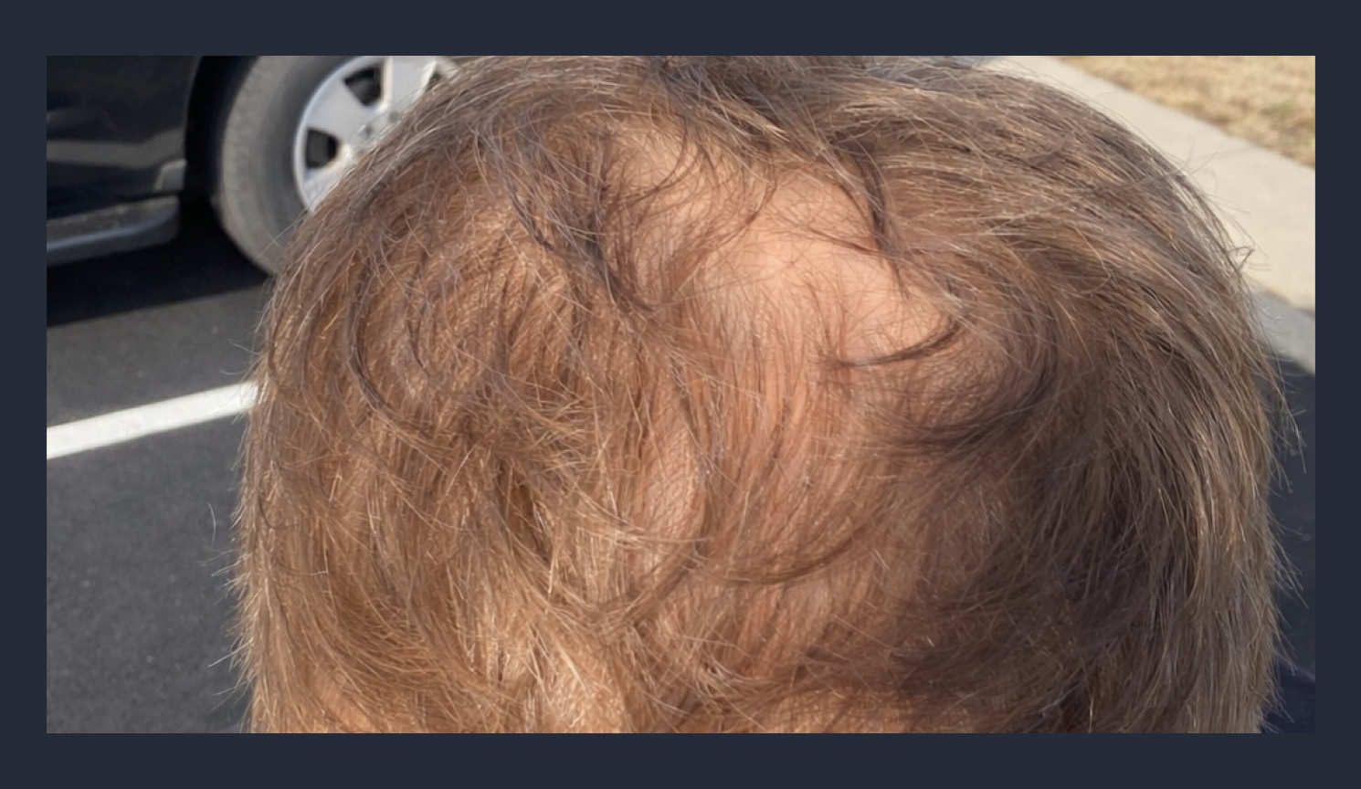 Why Is Your Crown Thinning — And What Can You Do About It?