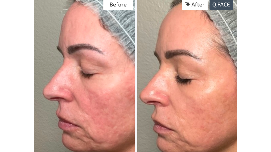 Facial Rejuvenation Cost Guide 2026: What to Expect, Pricing Factors, and Smart Ways to Invest in Your Skin