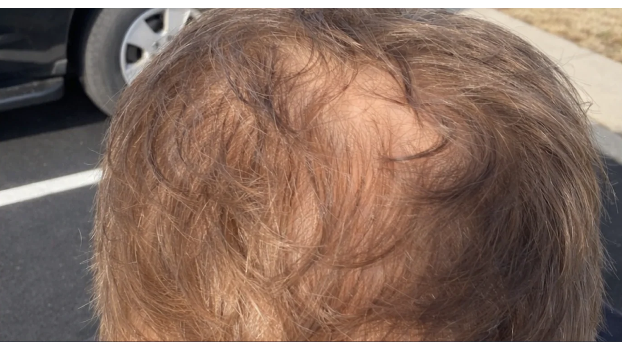 What Are the Early Signs of Balding? How to Recognize Changes Early and Support Fuller-Looking Hair