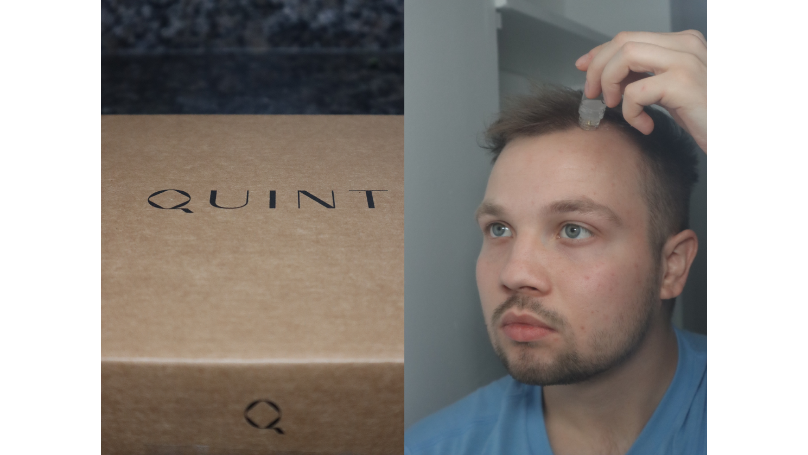 Why Is Your Crown Thinning — And What Can You Do About It?