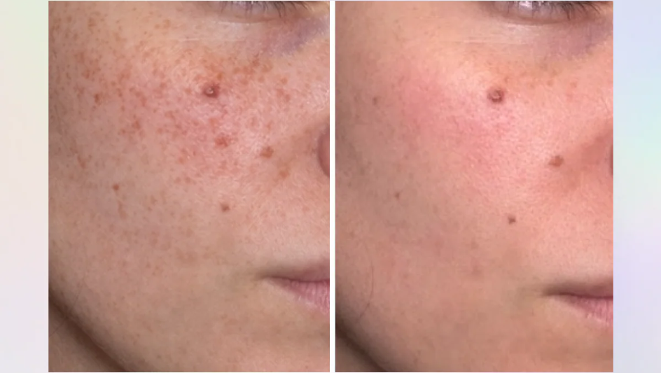 Exosome Injections Explained: What Are They For? Modern Skin Vitality Approaches Beyond Traditional Facials