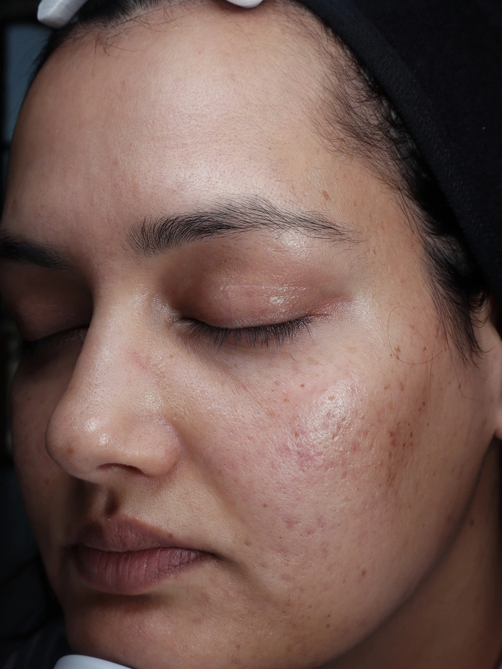 Q.FACE participant at baseline