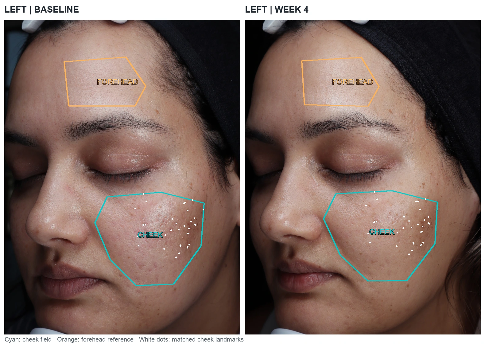 Left facial photographs with cyan cheek measurement regions and orange forehead reference regions