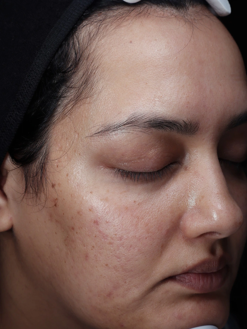 Q.FACE participant right facial view at baseline