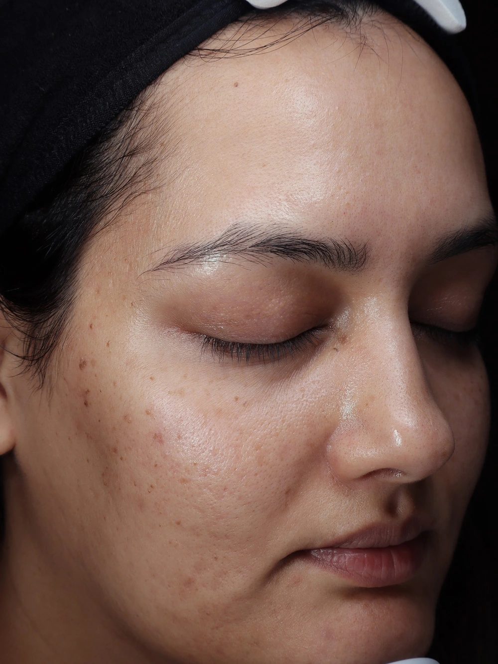 Q.FACE participant right facial view at week 4