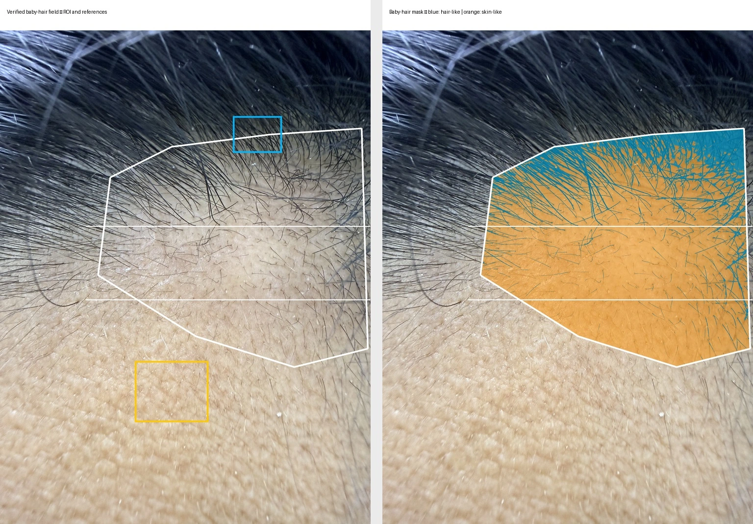 Follow-up frontal baby-hair close-up with analysis mask and three measurement zones