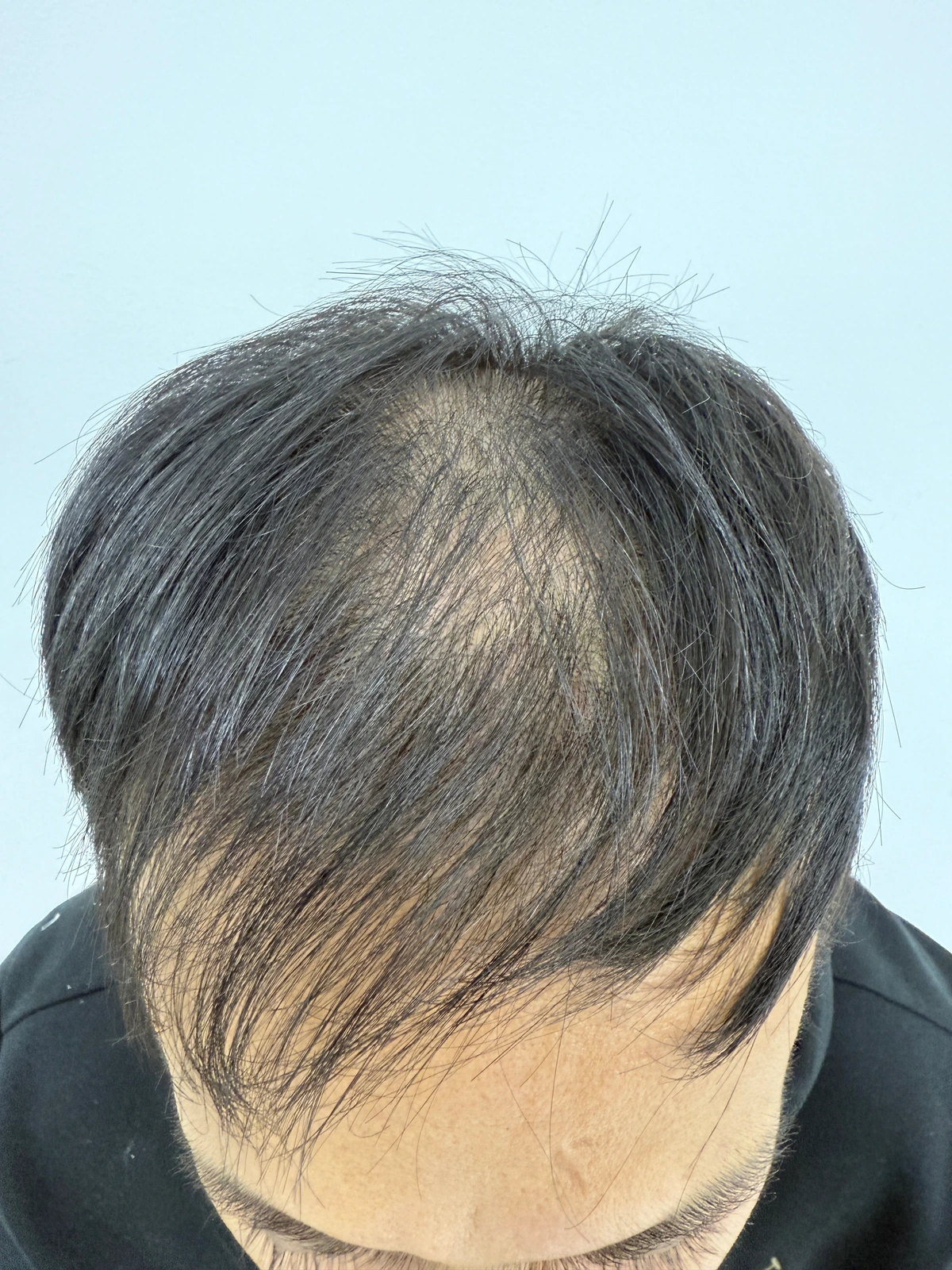 Q.SCALP participant at baseline