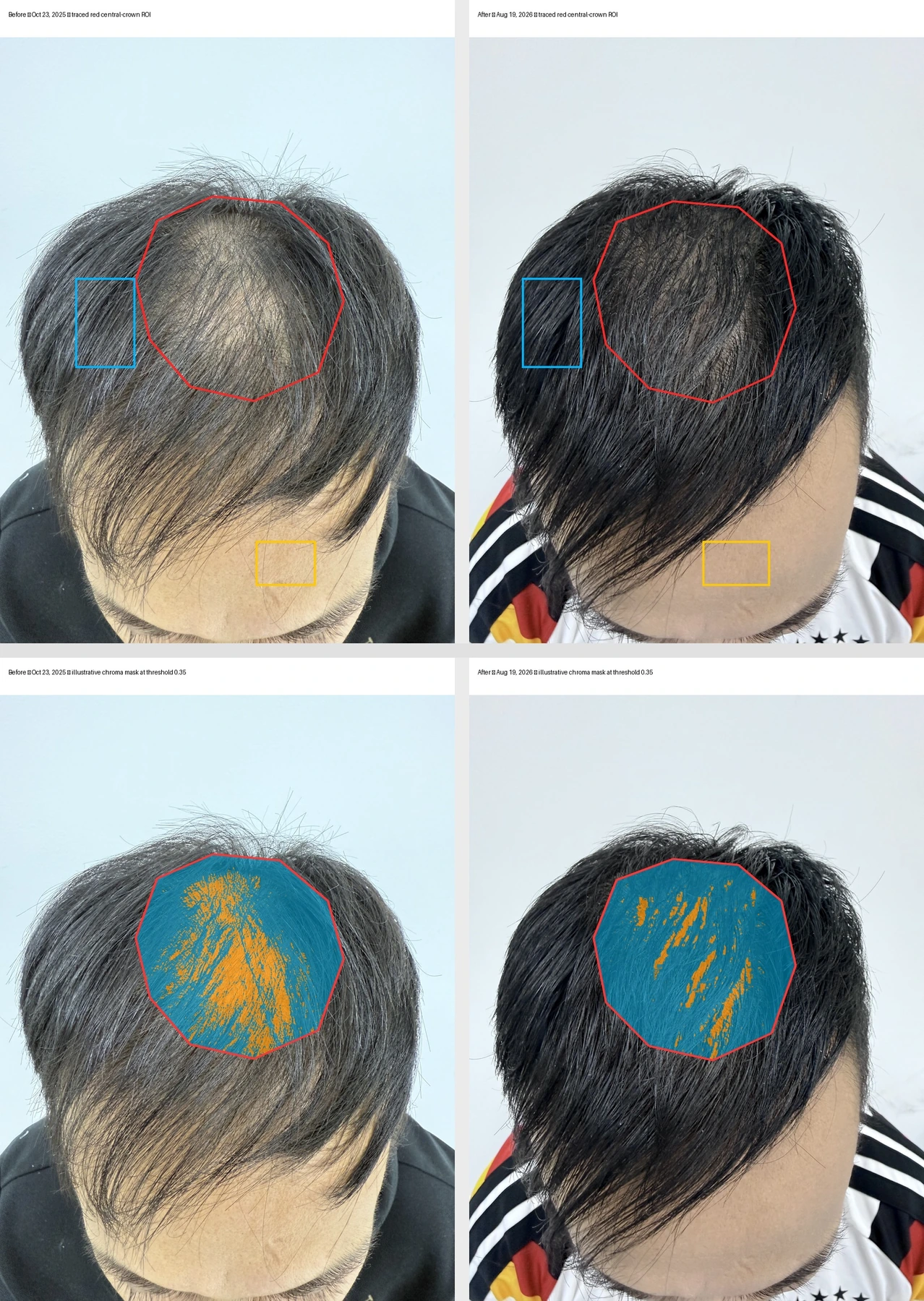 Central-crown region outlines and scalp-like versus hair-like pixel classification overlays