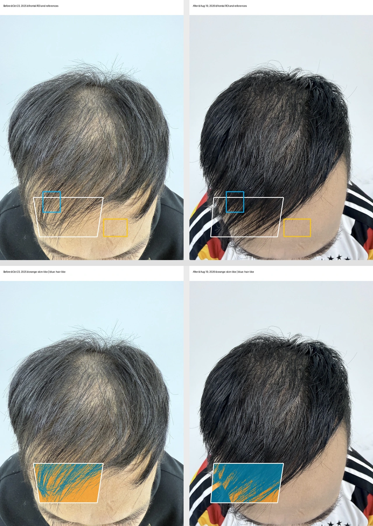 Baseline and follow-up frontal-fringe regions and their hair-like pixel overlays