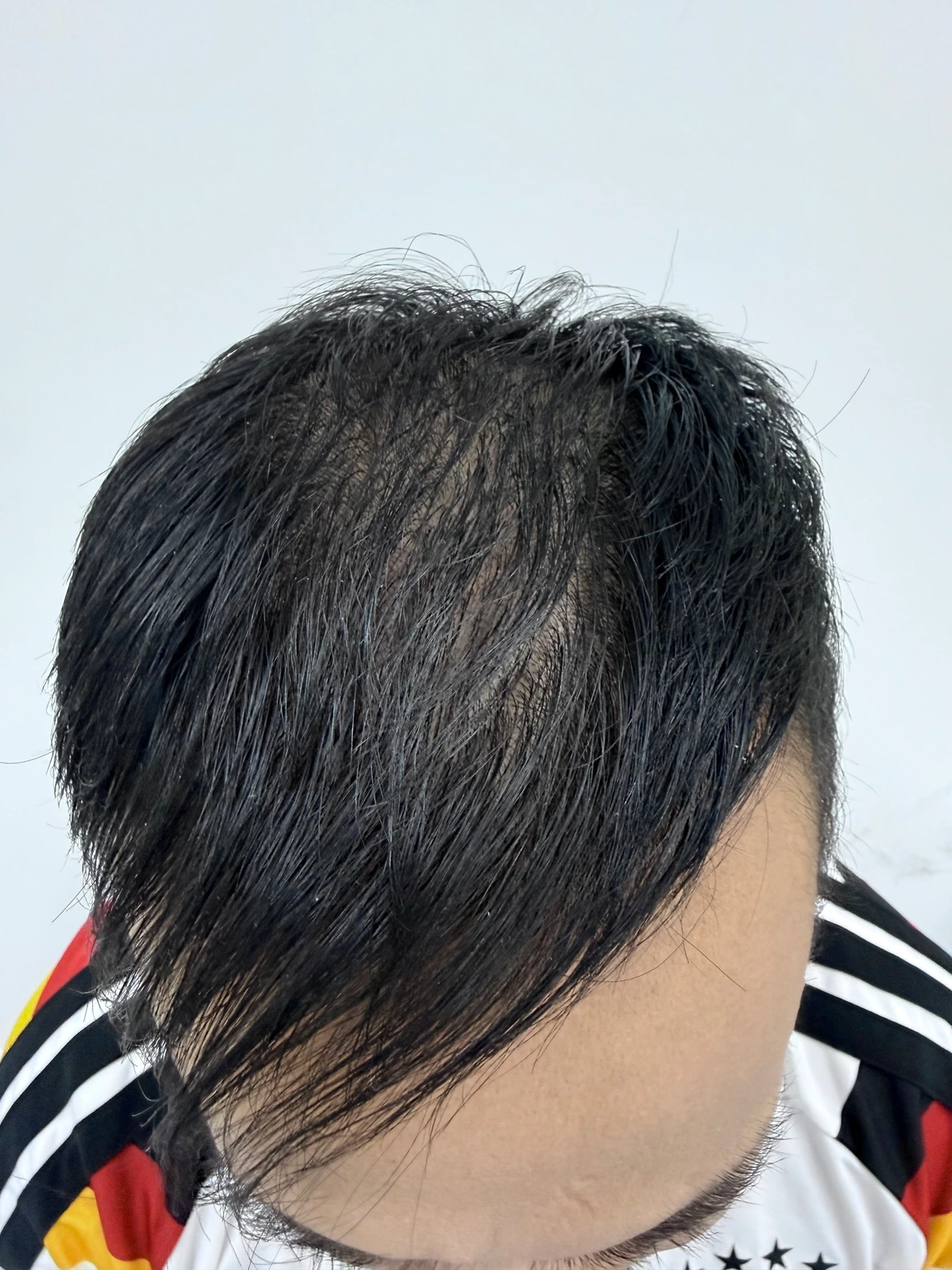 Q.SCALP participant at month 10